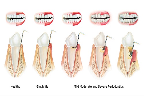 Gingivitis/Paradontitis